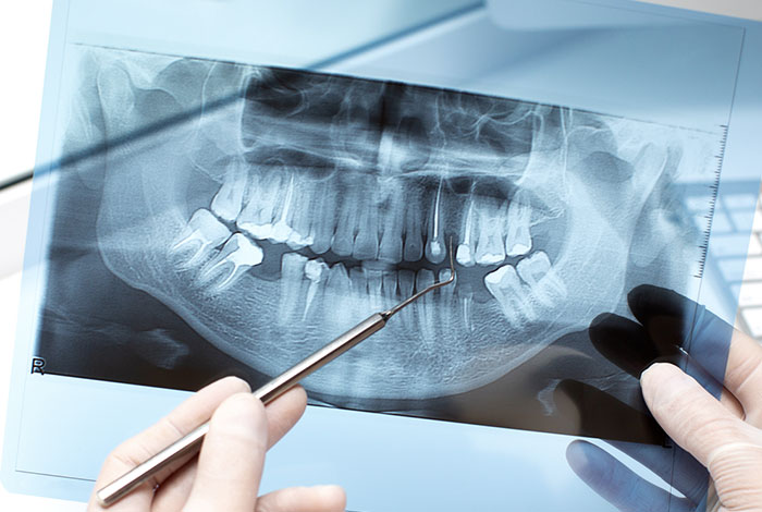 Endodontics (Root Canal Treatment) | Paray Dental Home